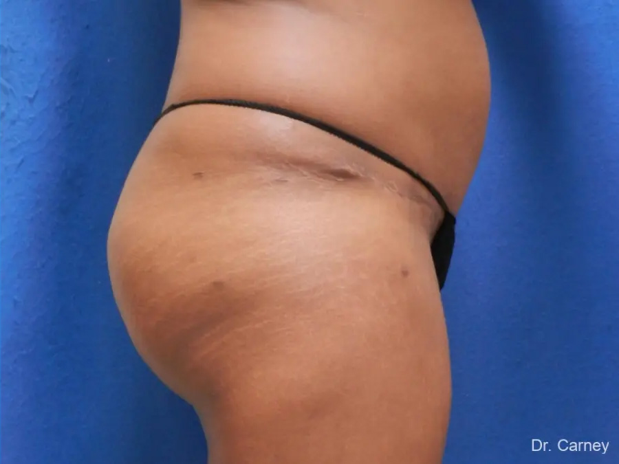 Tummy Tuck Real Patient Results by Dr. Martin Carney and Dr. Martin Carney III of The Carney Center in Virginia Beach and Newport News