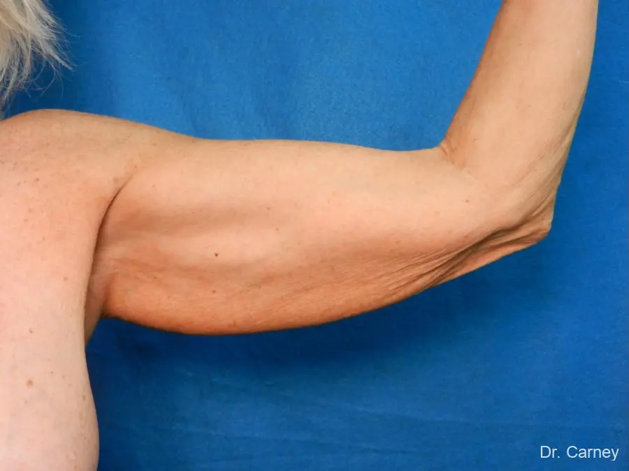 Arm Lift Real Patient Results by Dr. Martin Carney and Dr. Martin Carney III of The Carney Center in Virginia Beach and Newport News