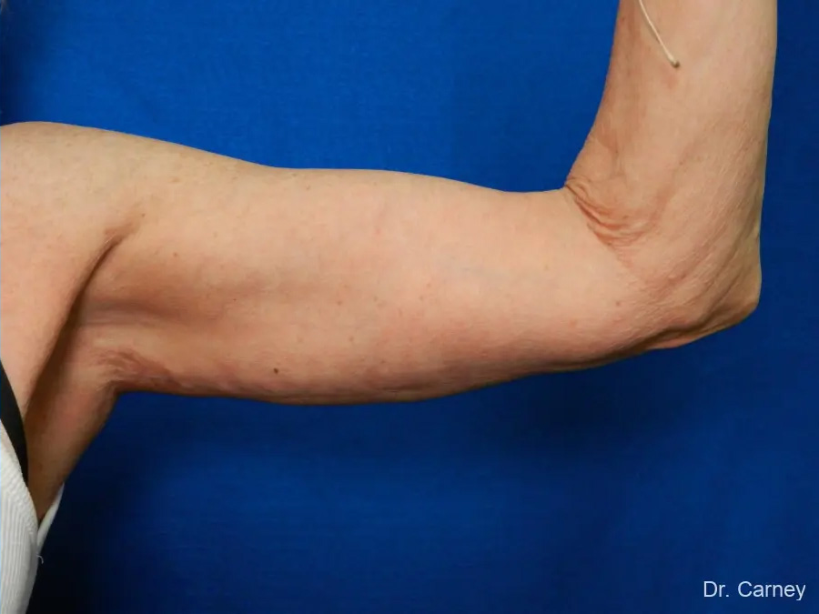 Arm Lift Real Patient Results by Dr. Martin Carney and Dr. Martin Carney III of The Carney Center in Virginia Beach and Newport News