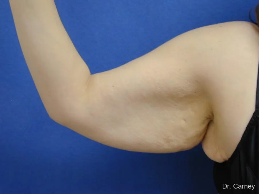 Arm Lift Real Patient Results by Dr. Martin Carney and Dr. Martin Carney III of The Carney Center in Virginia Beach and Newport News
