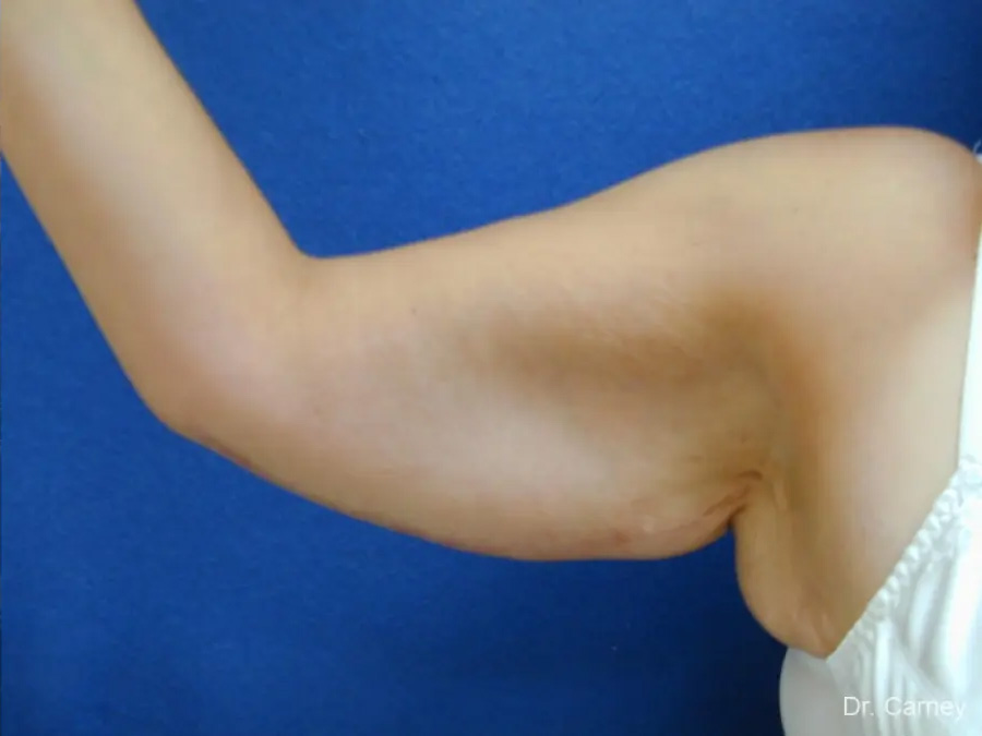Arm Lift Real Patient Results by Dr. Martin Carney and Dr. Martin Carney III of The Carney Center in Virginia Beach and Newport News