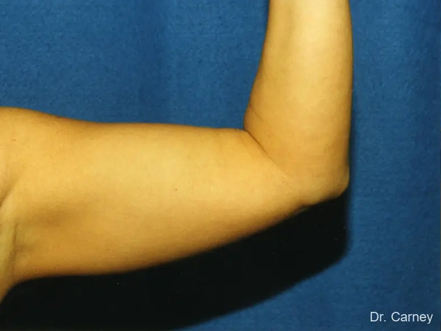 Arm Lift Real Patient Results by Dr. Martin Carney and Dr. Martin Carney III of The Carney Center in Virginia Beach and Newport News