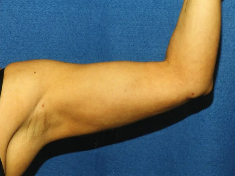 Arm Lift Real Patient Results by Dr. Martin Carney and Dr. Martin Carney III of The Carney Center in Virginia Beach and Newport News