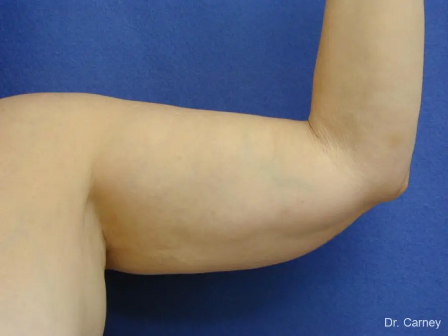 Arm Lift Real Patient Results by Dr. Martin Carney and Dr. Martin Carney III of The Carney Center in Virginia Beach and Newport News