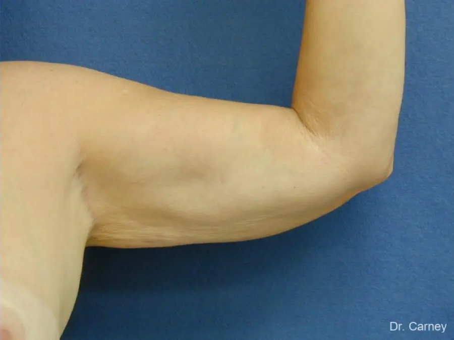 Arm Lift Real Patient Results by Dr. Martin Carney and Dr. Martin Carney III of The Carney Center in Virginia Beach and Newport News