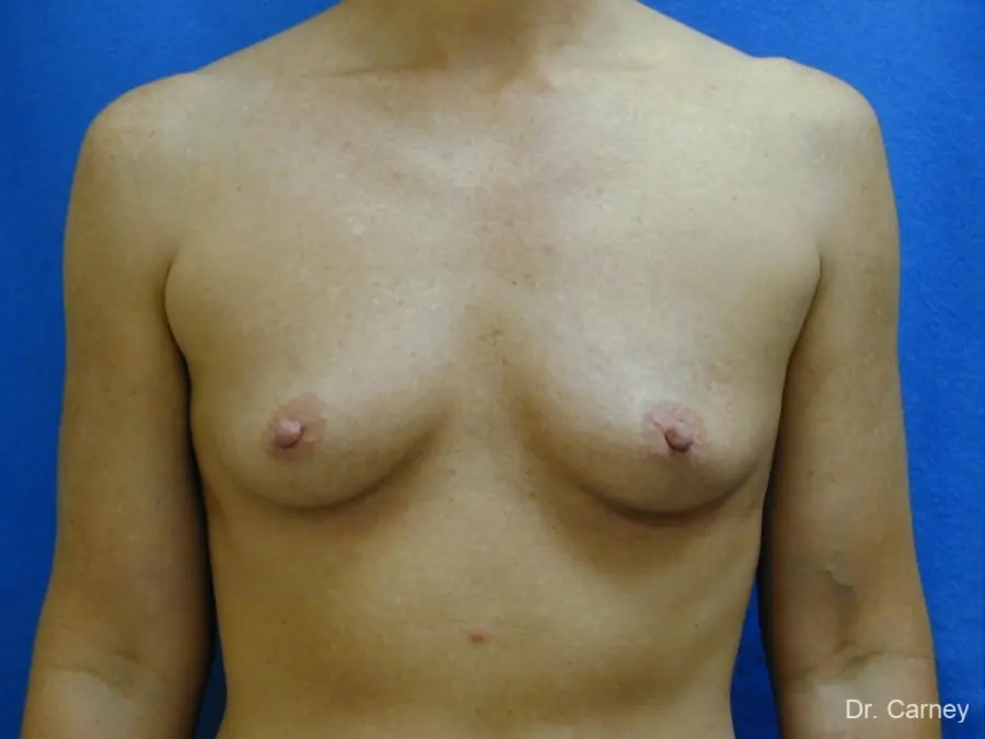 Breast Augmentation Real Patient Results by Dr. Martin Carney and Dr. Martin Carney III of The Carney Center in Virginia Beach and Newport News