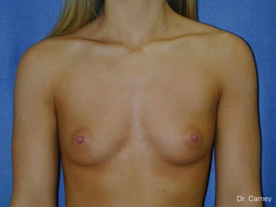 Breast Augmentation Real Patient Results by Dr. Martin Carney and Dr. Martin Carney III of The Carney Center in Virginia Beach and Newport News