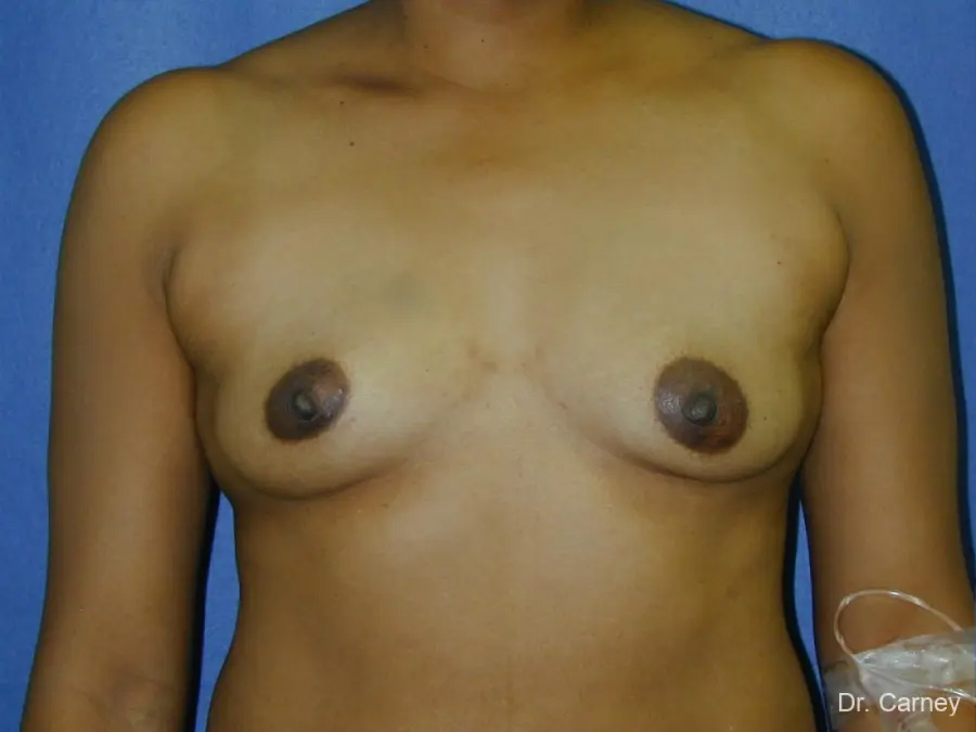 Breast Augmentation Real Patient Results by Dr. Martin Carney and Dr. Martin Carney III of The Carney Center in Virginia Beach and Newport News
