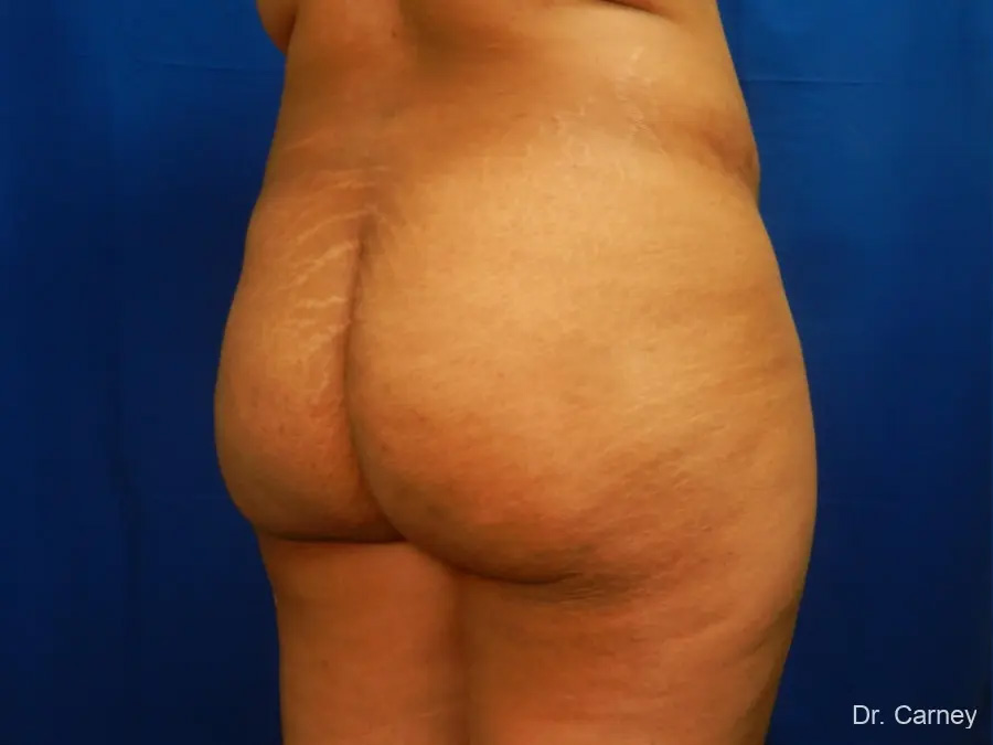 Brazilian Butt Lift Real Patient Results by Dr. Martin Carney and Dr. Martin Carney III of The Carney Center in Virginia Beach and Newport News