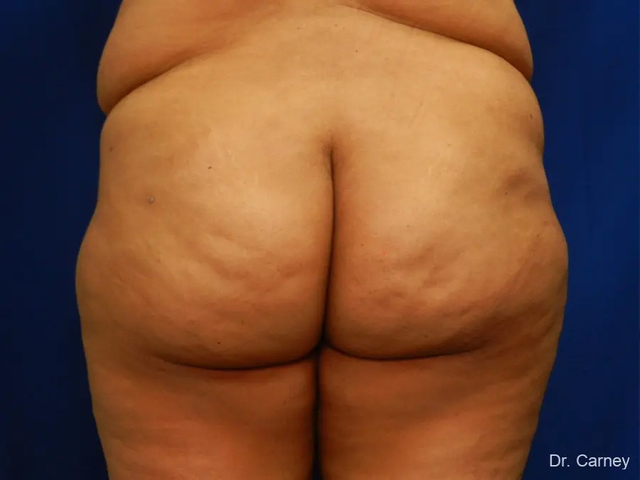 Brazilian Butt Lift Real Patient Results by Dr. Martin Carney and Dr. Martin Carney III of The Carney Center in Virginia Beach and Newport News