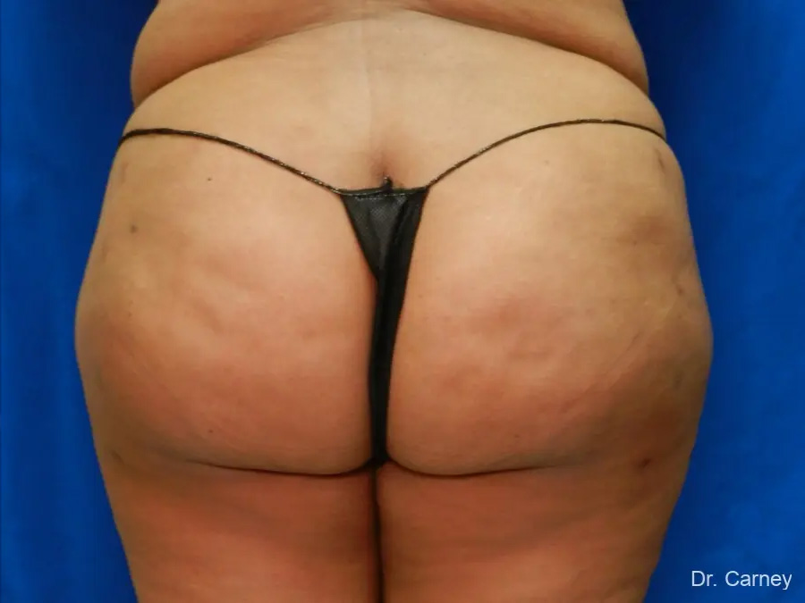 Brazilian Butt Lift Real Patient Results by Dr. Martin Carney and Dr. Martin Carney III of The Carney Center in Virginia Beach and Newport News