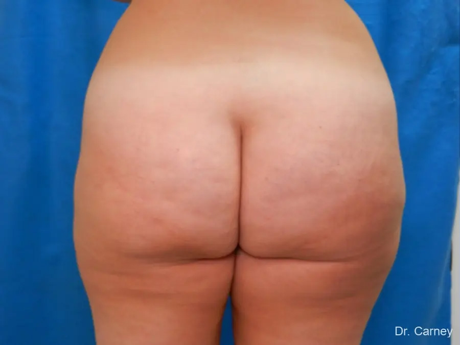 Brazilian Butt Lift Real Patient Results by Dr. Martin Carney and Dr. Martin Carney III of The Carney Center in Virginia Beach and Newport News