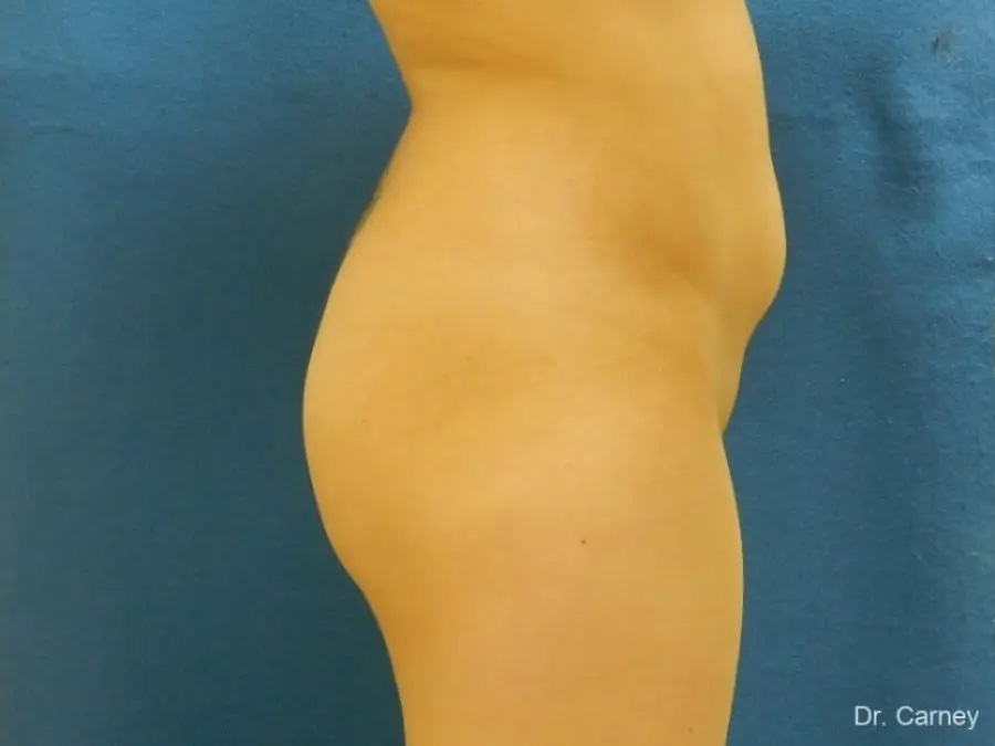 Brazilian Butt Lift Real Patient Results by Dr. Martin Carney and Dr. Martin Carney III of The Carney Center in Virginia Beach and Newport News