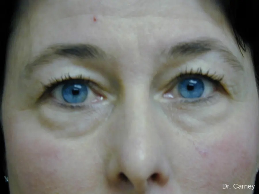 Facelift Real Patient Results by Dr. Martin Carney and Dr. Martin Carney III of The Carney Center in Virginia Beach and Newport News
