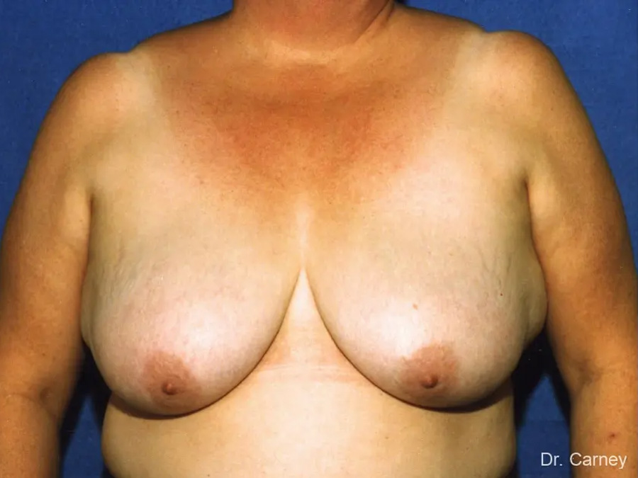 Breast Lift Real Patient Results by Dr. Martin Carney and Dr. Martin Carney III of The Carney Center in Virginia Beach and Newport News