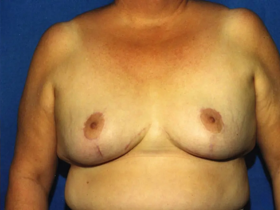 Breast Lift Real Patient Results by Dr. Martin Carney and Dr. Martin Carney III of The Carney Center in Virginia Beach and Newport News
