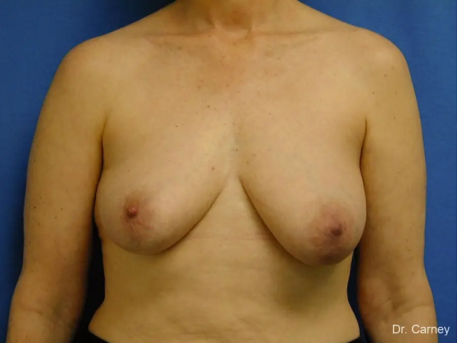 Breast Lift Real Patient Results by Dr. Martin Carney and Dr. Martin Carney III of The Carney Center in Virginia Beach and Newport News