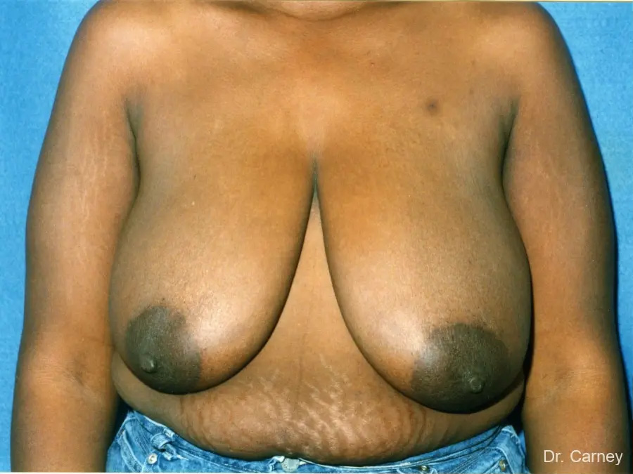Breast Reduction Real Patient Results by Dr. Martin Carney and Dr. Martin Carney III of The Carney Center in Virginia Beach and Newport News
