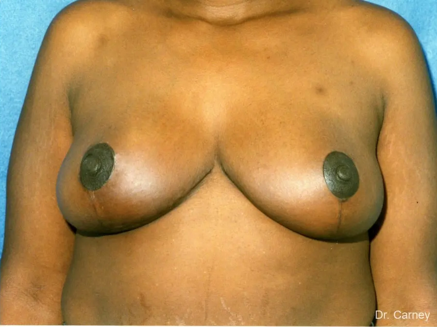 Breast Lift Real Patient Results by Dr. Martin Carney and Dr. Martin Carney III of The Carney Center in Virginia Beach and Newport News