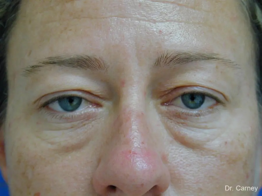 Facelift Real Patient Results by Dr. Martin Carney and Dr. Martin Carney III of The Carney Center in Virginia Beach and Newport News