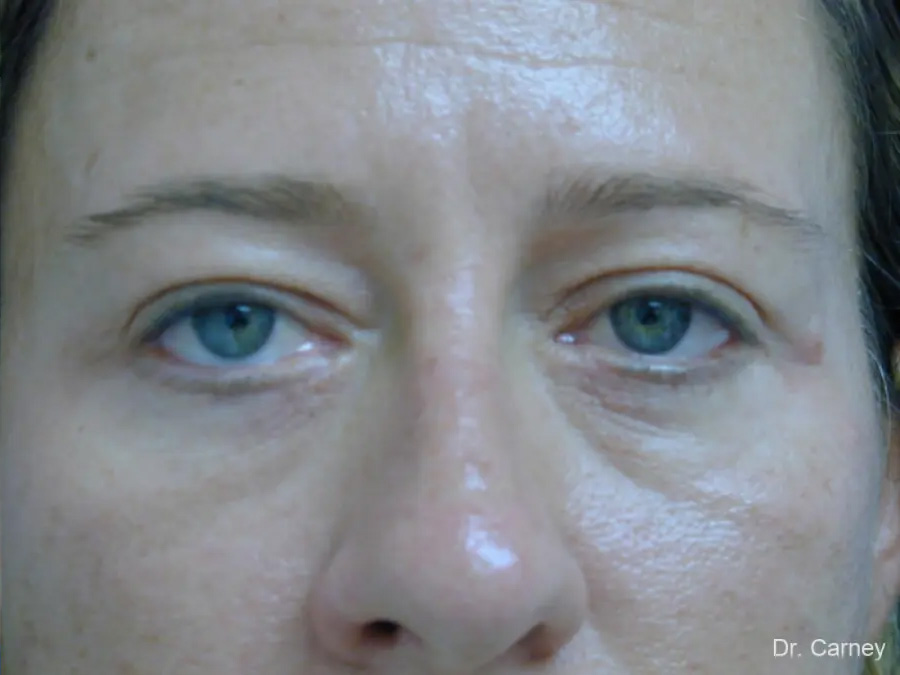 Blepharoplasaty Real Patient Results by Dr. Martin Carney and Dr. Martin Carney III of The Carney Center in Virginia Beach and Newport News