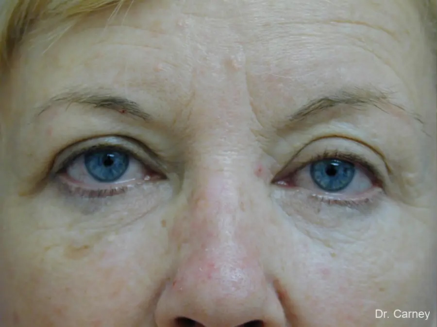 Facelift Real Patient Results by Dr. Martin Carney and Dr. Martin Carney III of The Carney Center in Virginia Beach and Newport News