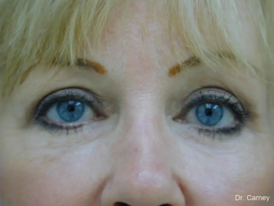Blepharoplasaty Real Patient Results by Dr. Martin Carney and Dr. Martin Carney III of The Carney Center in Virginia Beach and Newport News