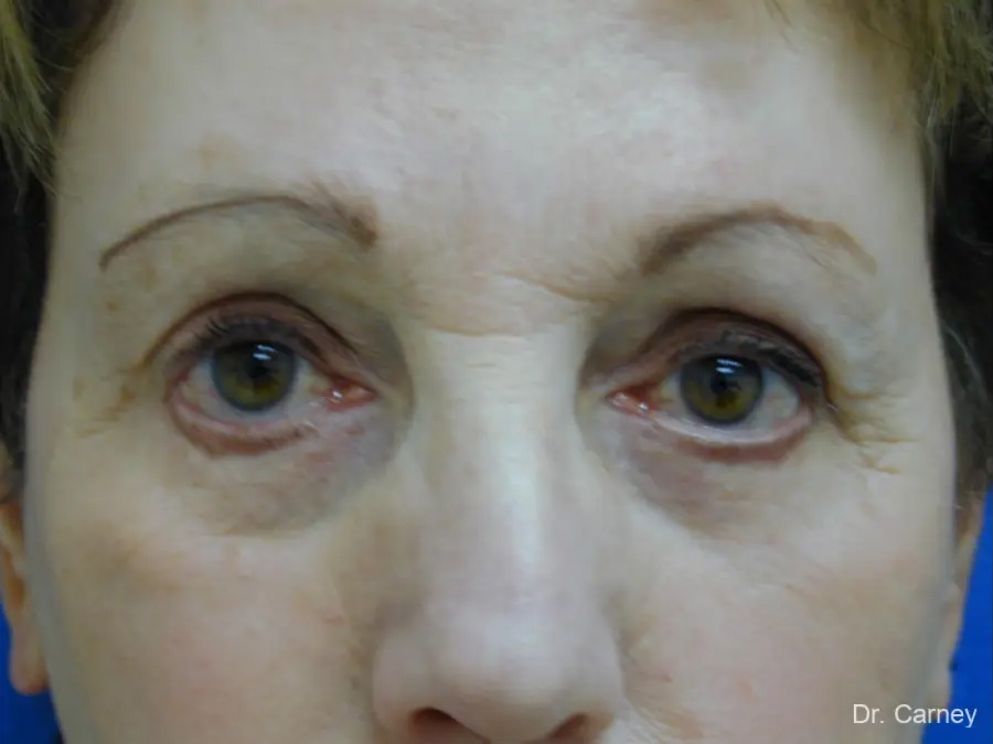 Facelift Real Patient Results by Dr. Martin Carney and Dr. Martin Carney III of The Carney Center in Virginia Beach and Newport News