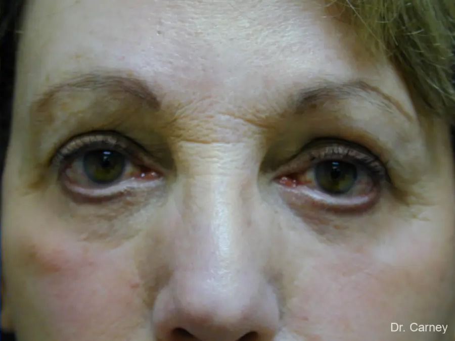 Blepharoplasaty Real Patient Results by Dr. Martin Carney and Dr. Martin Carney III of The Carney Center in Virginia Beach and Newport News