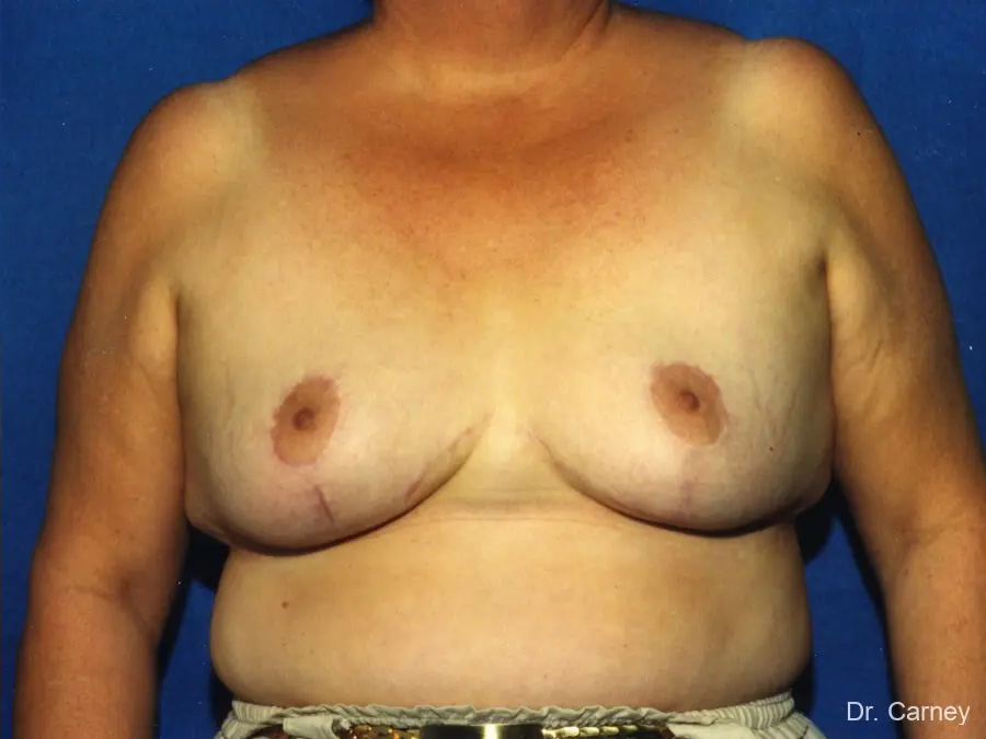 Breast Reduction Real Patient Results by Dr. Martin Carney and Dr. Martin Carney III of The Carney Center in Virginia Beach and Newport News