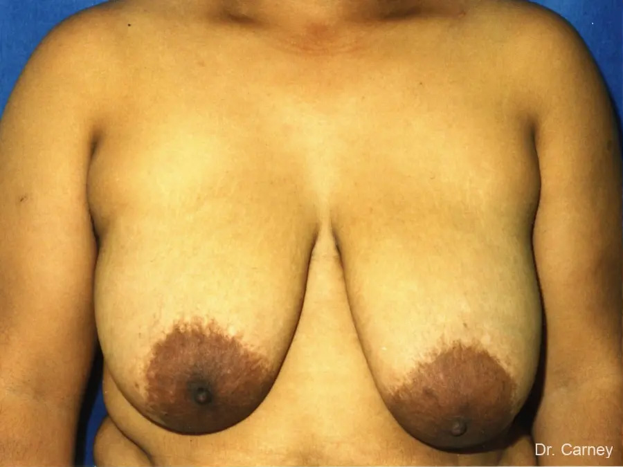 Breast Reduction Real Patient Results by Dr. Martin Carney and Dr. Martin Carney III of The Carney Center in Virginia Beach and Newport News