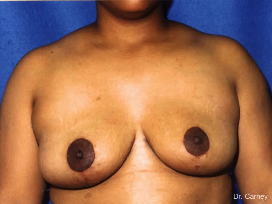 Breast Reduction Real Patient Results by Dr. Martin Carney and Dr. Martin Carney III of The Carney Center in Virginia Beach and Newport News