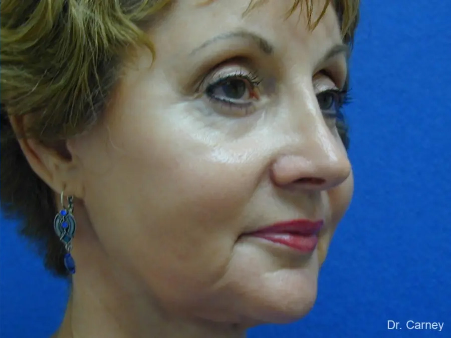 Brow Lift Real Patient Results by Dr. Martin Carney and Dr. Martin Carney III of The Carney Center in Virginia Beach and Newport News