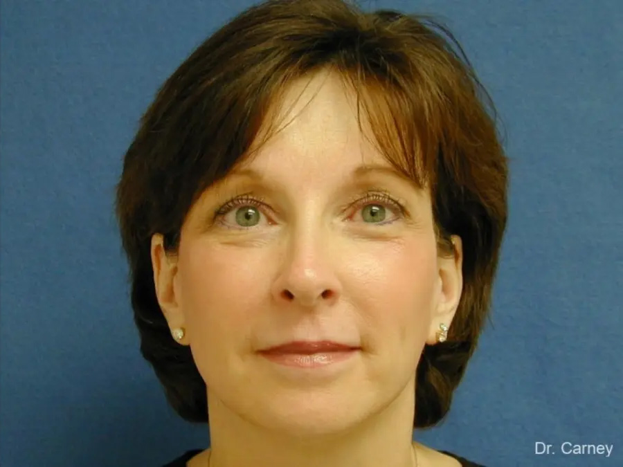 Brow Lift Real Patient Results by Dr. Martin Carney and Dr. Martin Carney III of The Carney Center in Virginia Beach and Newport News
