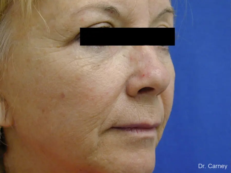 Brow Lift Real Patient Results by Dr. Martin Carney and Dr. Martin Carney III of The Carney Center in Virginia Beach and Newport News