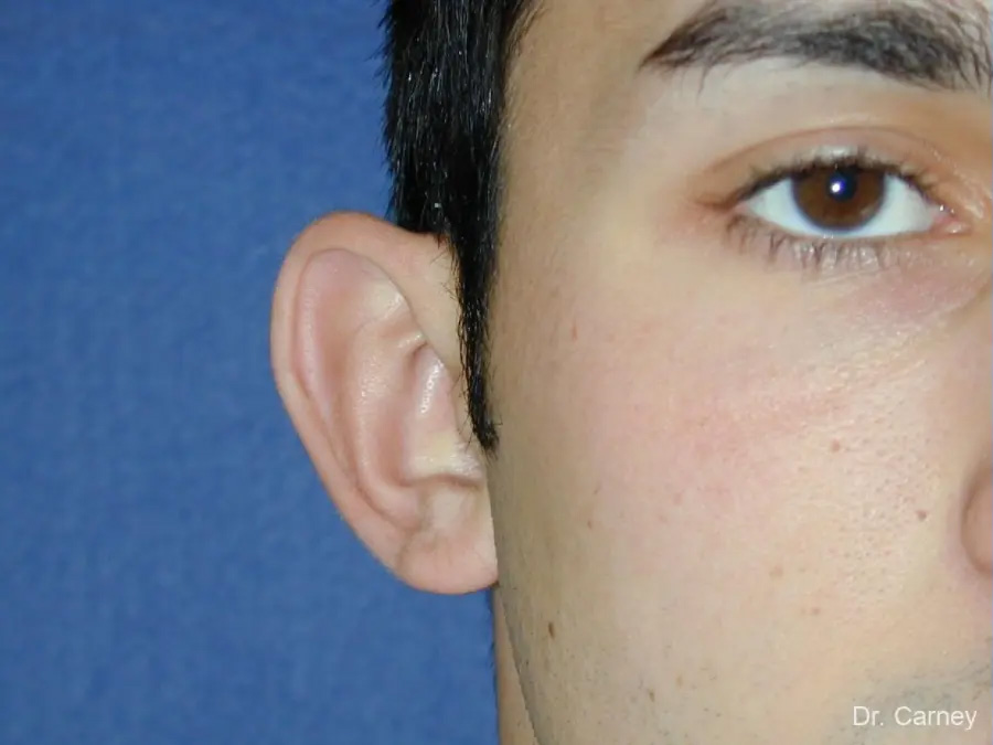 Ootoplasty Real Patient Results by Dr. Martin Carney and Dr. Martin Carney III of The Carney Center in Virginia Beach and Newport News