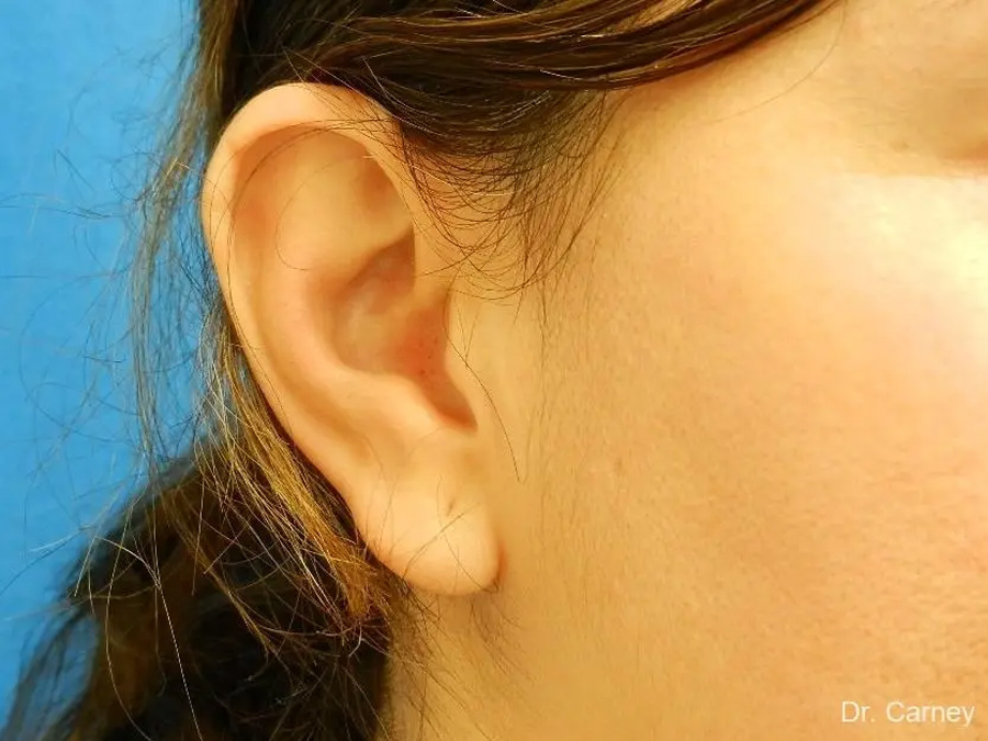 Ootoplasty Real Patient Results by Dr. Martin Carney and Dr. Martin Carney III of The Carney Center in Virginia Beach and Newport News