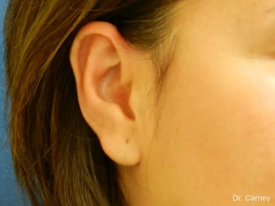 Otoplasty Real Patient Results by Dr. Martin Carney and Dr. Martin Carney III of The Carney Center in Virginia Beach and Newport News
