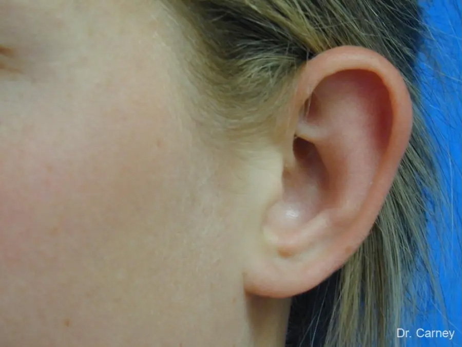 Ootoplasty Real Patient Results by Dr. Martin Carney and Dr. Martin Carney III of The Carney Center in Virginia Beach and Newport News