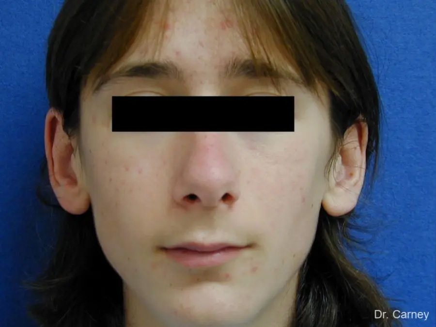 Ootoplasty Real Patient Results by Dr. Martin Carney and Dr. Martin Carney III of The Carney Center in Virginia Beach and Newport News