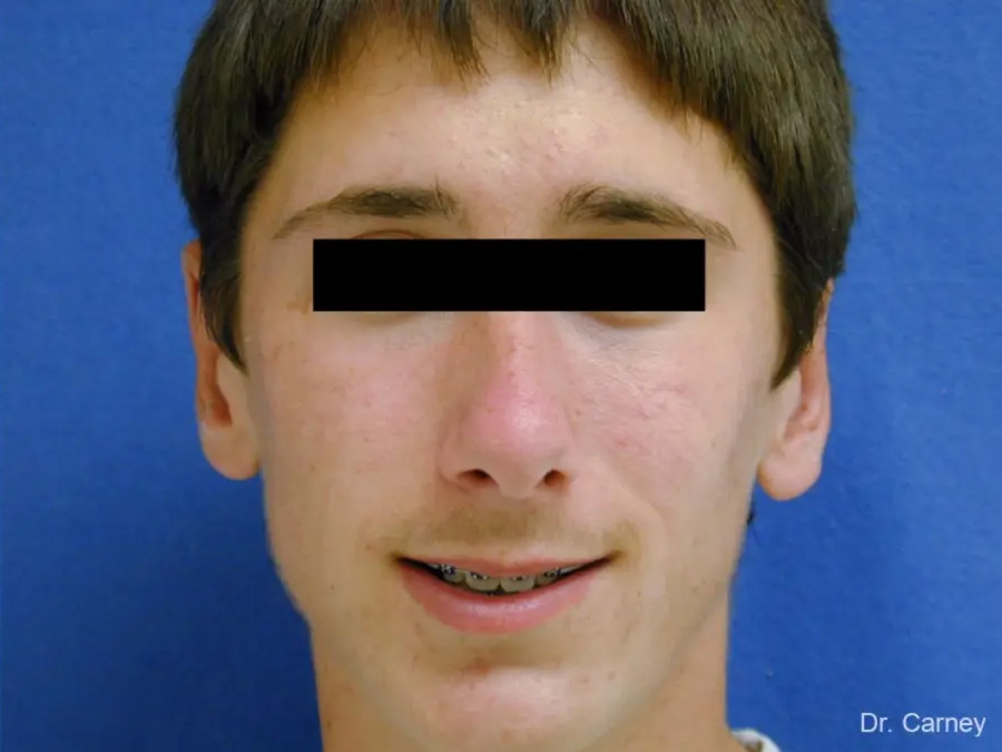 Otoplasty Real Patient Results by Dr. Martin Carney and Dr. Martin Carney III of The Carney Center in Virginia Beach and Newport News