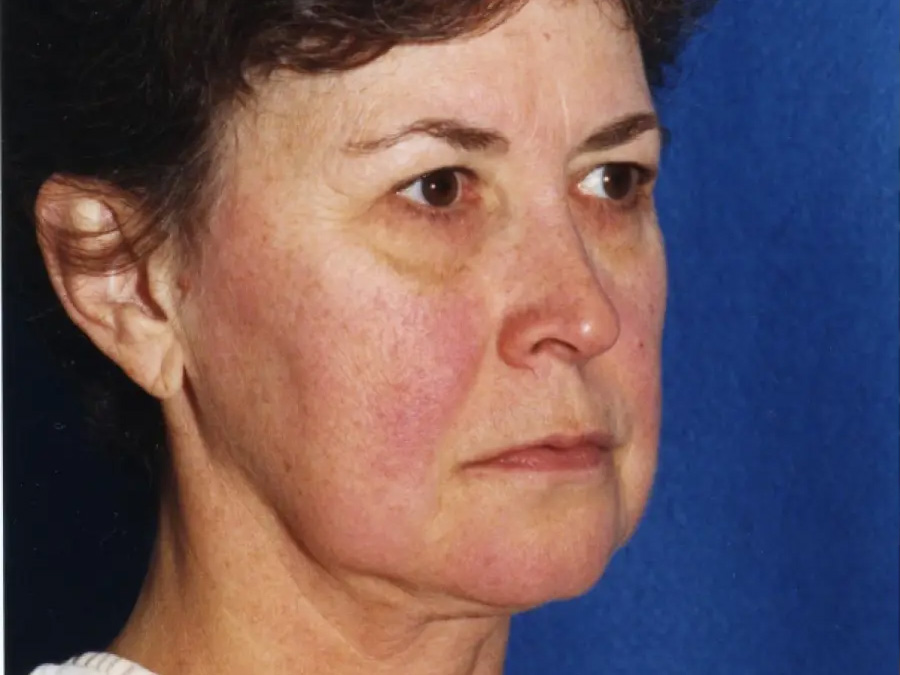 Facelift Real Patient Results by Dr. Martin Carney and Dr. Martin Carney III of The Carney Center in Virginia Beach and Newport News