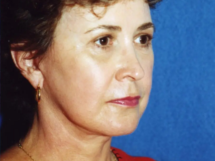 Facelift Real Patient Results by Dr. Martin Carney and Dr. Martin Carney III of The Carney Center in Virginia Beach and Newport News
