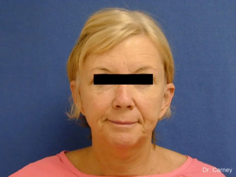 Facelift Real Patient Results by Dr. Martin Carney and Dr. Martin Carney III of The Carney Center in Virginia Beach and Newport News