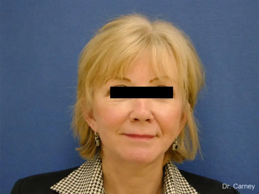 Facelift Real Patient Results by Dr. Martin Carney and Dr. Martin Carney III of The Carney Center in Virginia Beach and Newport News