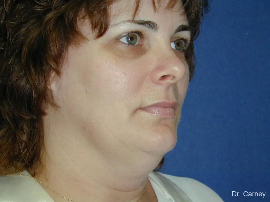 Facelift Real Patient Results by Dr. Martin Carney and Dr. Martin Carney III of The Carney Center in Virginia Beach and Newport News