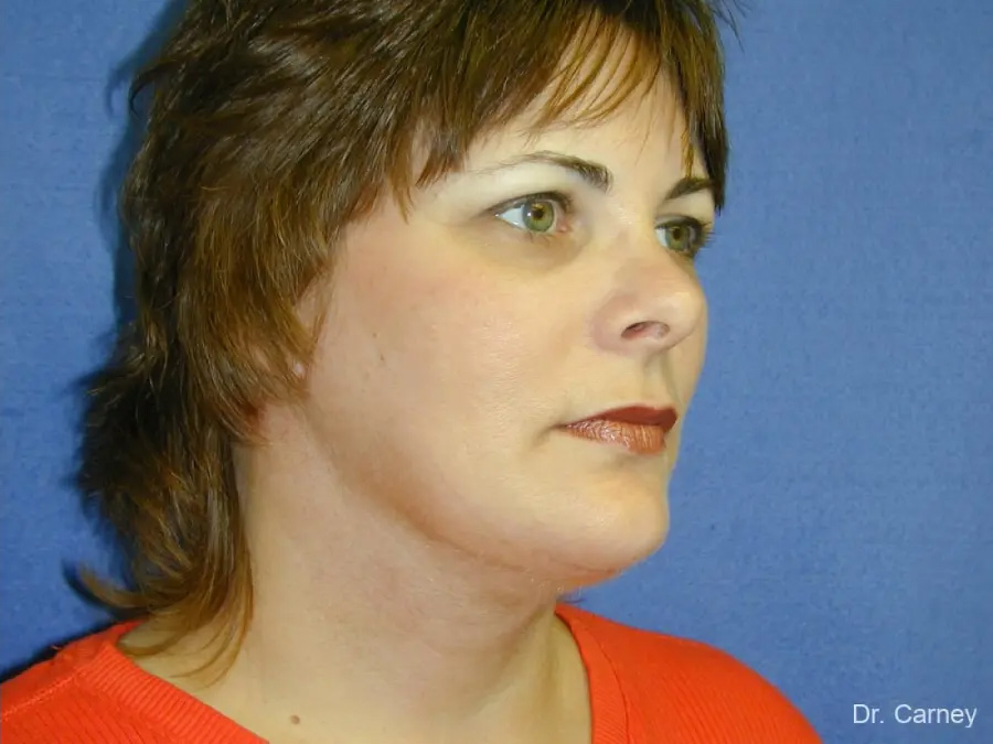 Facelift Real Patient Results by Dr. Martin Carney and Dr. Martin Carney III of The Carney Center in Virginia Beach and Newport News