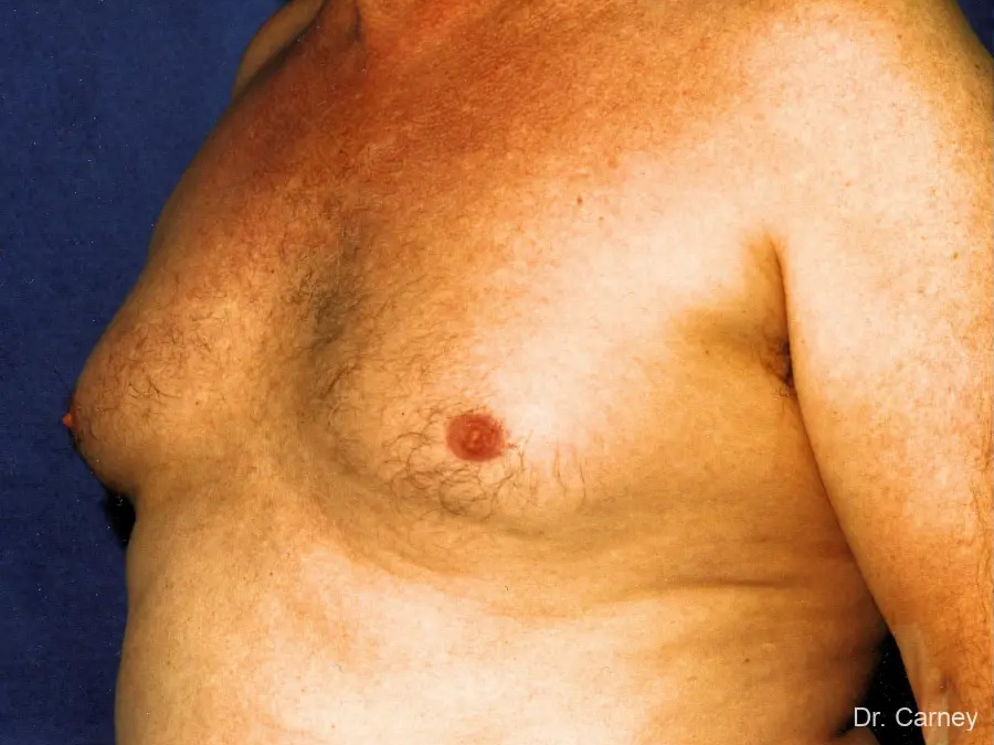 Gynecomastia Real Patient Results by Dr. Martin Carney and Dr. Martin Carney III of The Carney Center in Virginia Beach and Newport News