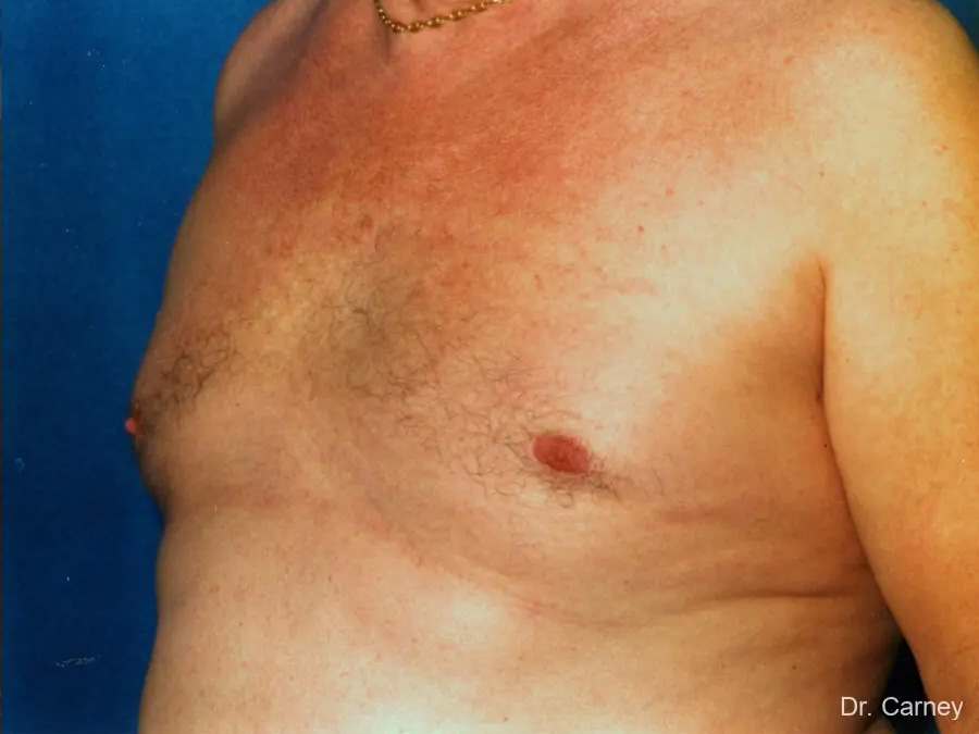 Gynecomastia Real Patient Results by Dr. Martin Carney and Dr. Martin Carney III of The Carney Center in Virginia Beach and Newport News