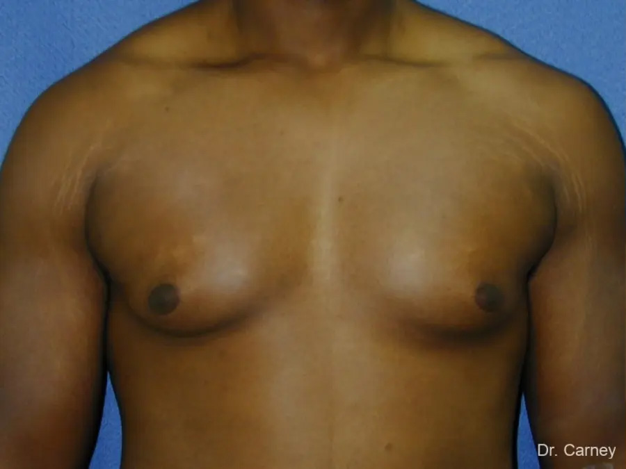 Gynecomastia Real Patient Results by Dr. Martin Carney and Dr. Martin Carney III of The Carney Center in Virginia Beach and Newport News